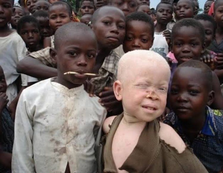 'Help Albinos Ward Off Skin Cancer' - Dr Bagudu Urges Nigerians