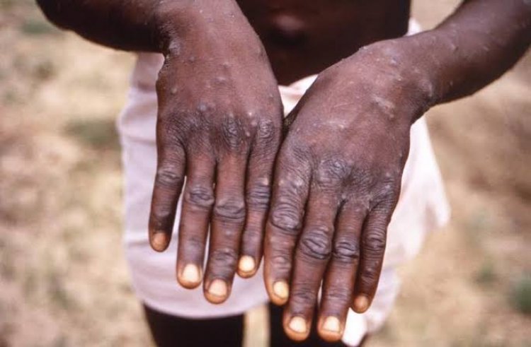 NCDC Confirms 15 Cases Of Monkeypox In Nigeria