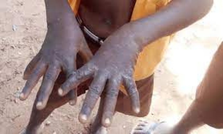C/R: Rashes and other skin diseases detected in Adjumako Ekwamoasi due to water shortage