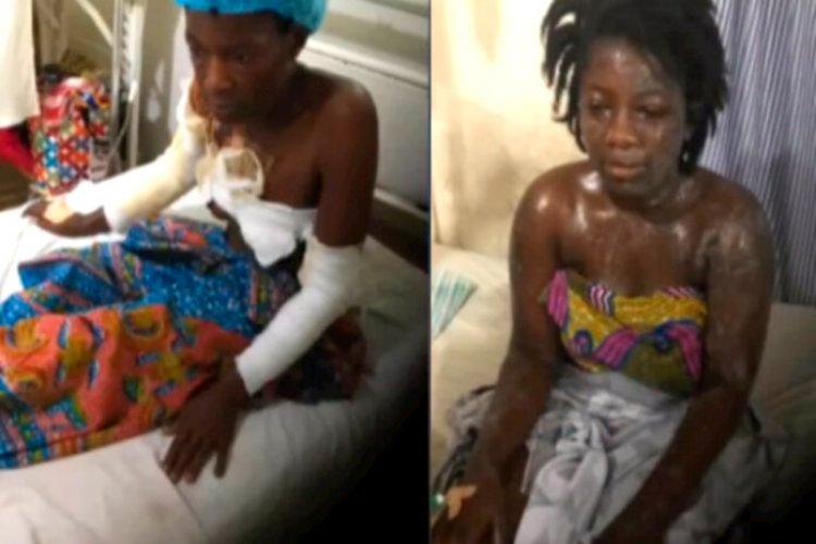 Sugar Daddy Pours Acid On Girlfriend And Mother For Reporting Him To The Police