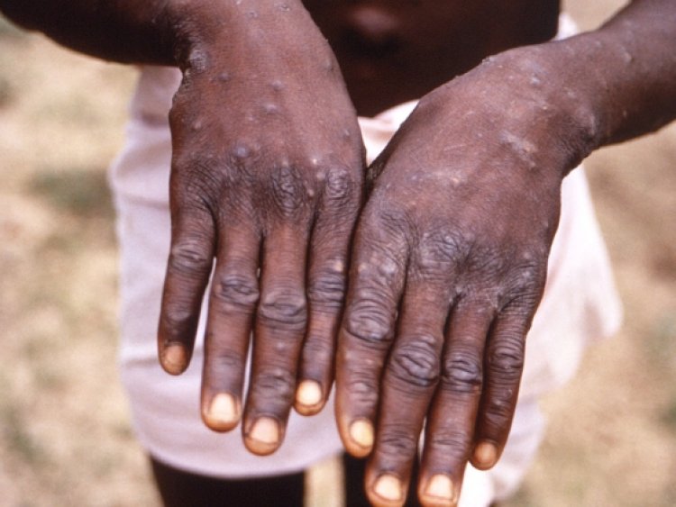 The first case of monkeypox in the United States has been discovered.