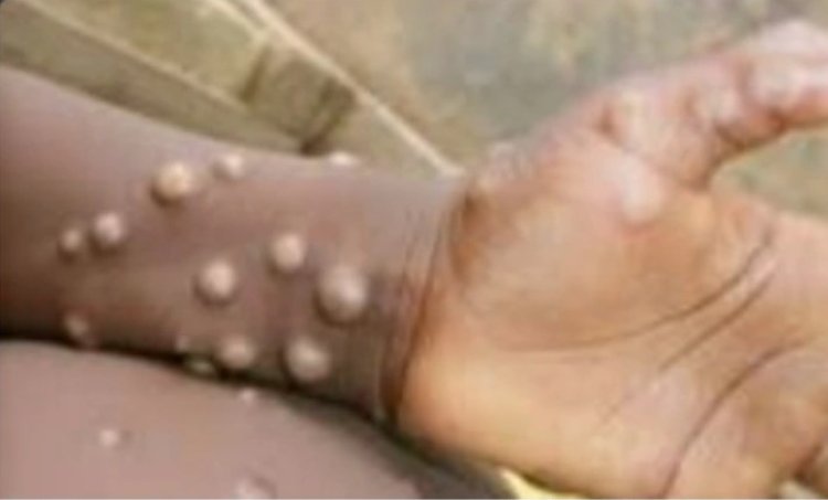 Monkey Pox Finally Arrives In Ghana, 5 Cases Recorded- GHS Confirmed