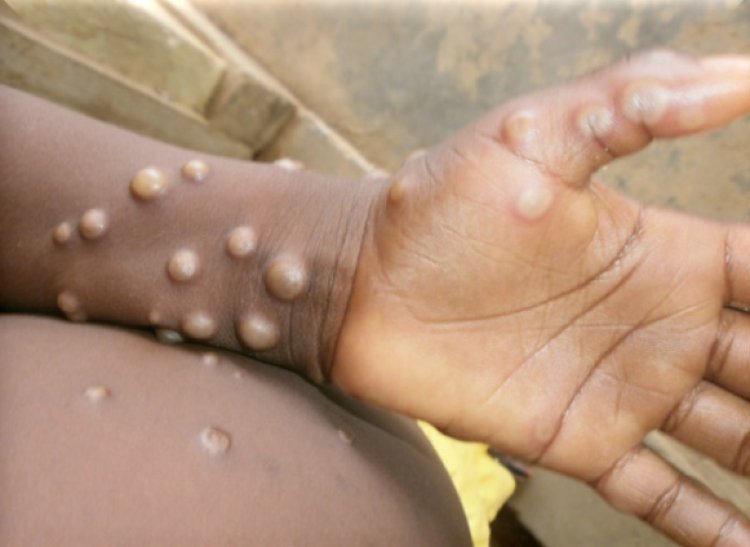 The disease monkeypox can be avoided by wearing a nasal mask and using hand sanitizer  – Virologist