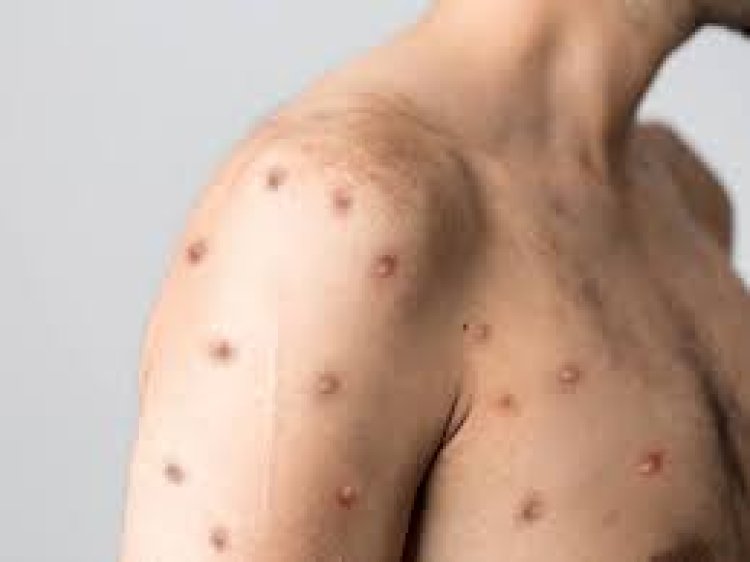 All you must know about monkeypox