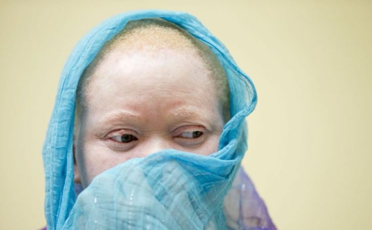 Man sentenced to life in prison for killing his albino sibling