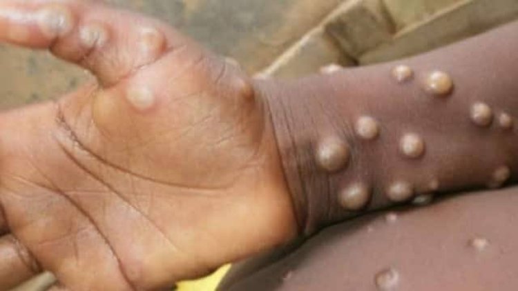 Monkeypox Disease: Osun Assembly Calls For Urgent Action