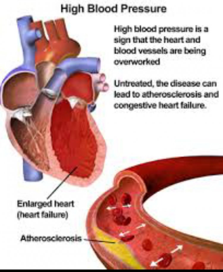 Hypertension Can Cause Erectile Dysfunction – Cardiologist